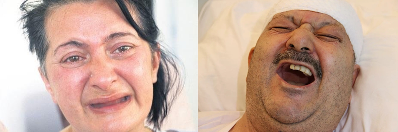Meral Erden: İnsanları İntihara Götüren Hastalık: Trigeminal Nevralji 23