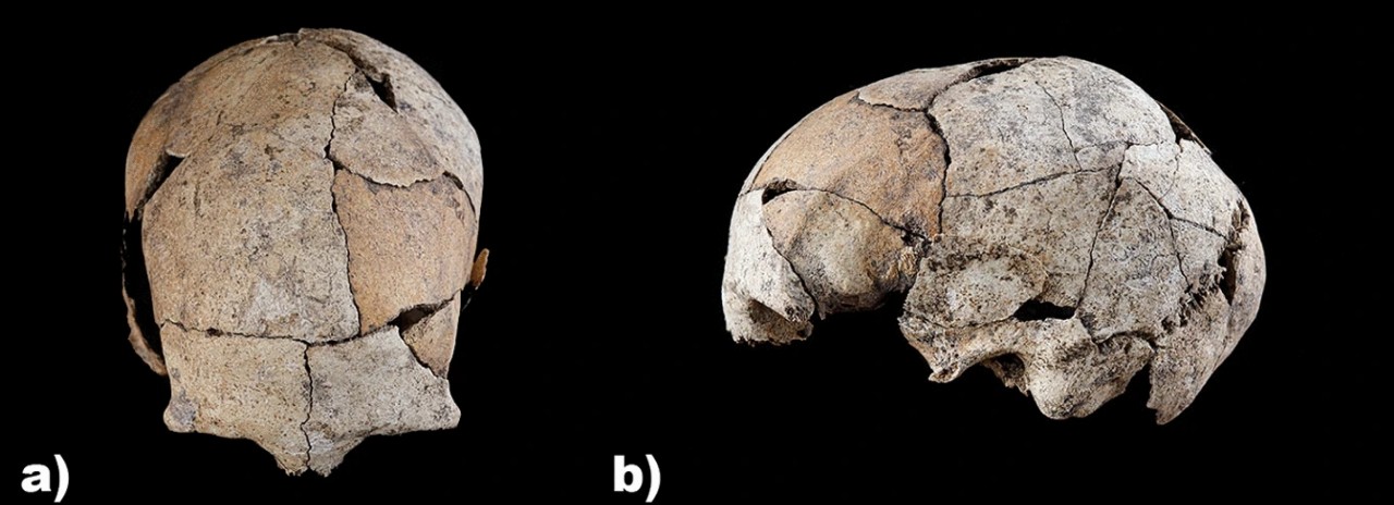 Şinasi Kaya: Birinci Kulak Ameliyatının 6 Bin Yıl Evvel Yapıldığı Keşfedildi 1