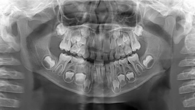 İnanç Can Çekmez: Dişlerimiz Kemik Sayılır mı? Dişler Kemik midir? Karşılığı Veriyoruz! 1