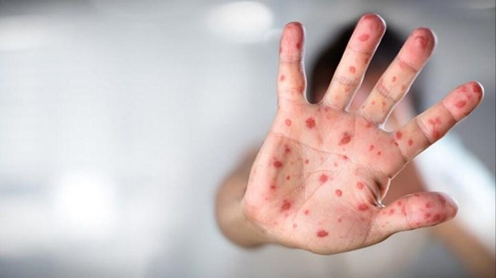 Şinasi Kaya: Maymun Çiceği Virüsü Hakkında Kritik Açıklama: 6 Ila 12 Kat Daha Süratli Mutasyona Uğruyor 1