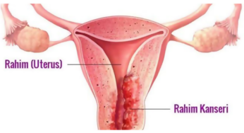 Hem Bayanlar Hem Erkekler İçin Tehlikeli Olan HPV Nedir?