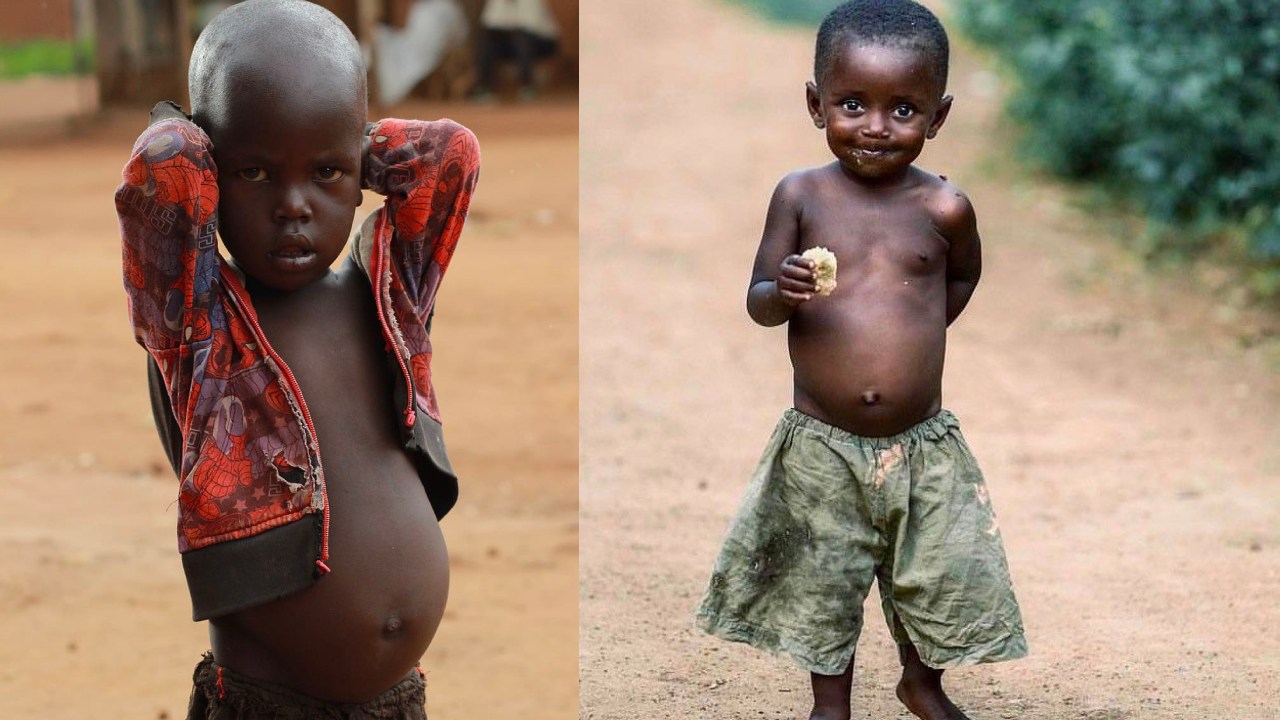 Şinasi Kaya: Açlık Çeken Çocukların Karınları Neden Şişkindir? - Webtekno 7