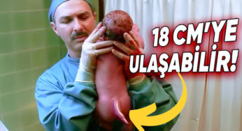Bazı Bebekler Nasıl Oluyor da Kuyruk Benzeri Bir Yapıyla Dünyaya Gelebiliyor?