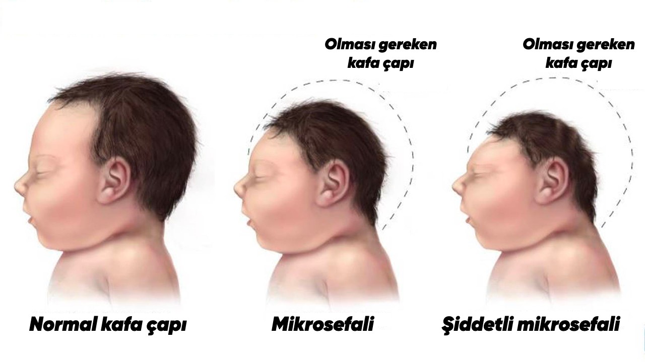 İnanç Can Çekmez: Bazı Yeni Doğan Bebeklerde Sıra Dışı Bir Kafa Görünümüne Sebebiyet Veren Rahatsızlık: Mikrosefali 1
