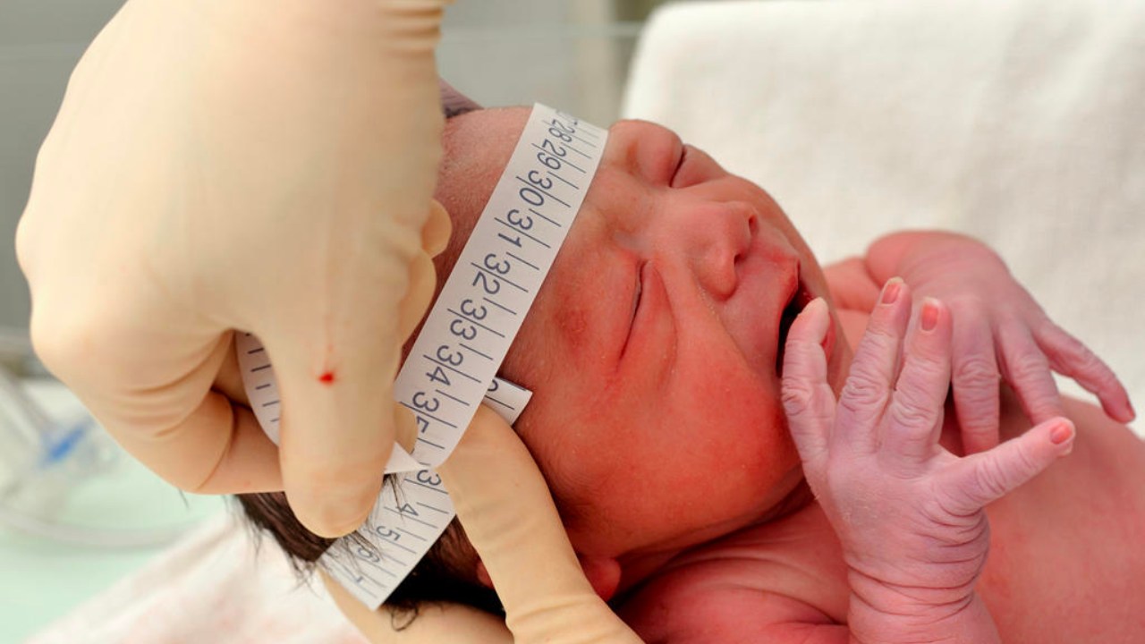 Ulaş Utku Bozdoğan: Bazı Yeni Doğan Bebeklerde Sıra Dışı Bir Kafa Görünümüne Sebebiyet Veren Rahatsızlık: Mikrosefali 13