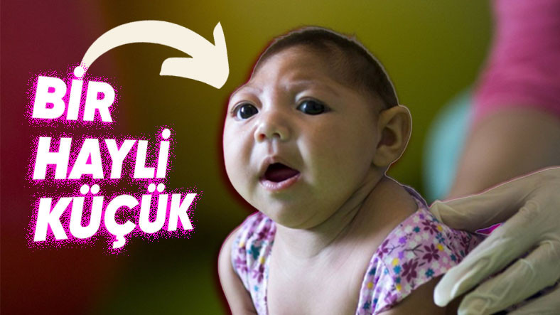 İnanç Can Çekmez: Bazı Yeni Doğan Bebeklerde Sıra Dışı Bir Kafa Görünümüne Sebebiyet Veren Rahatsızlık: Mikrosefali 11