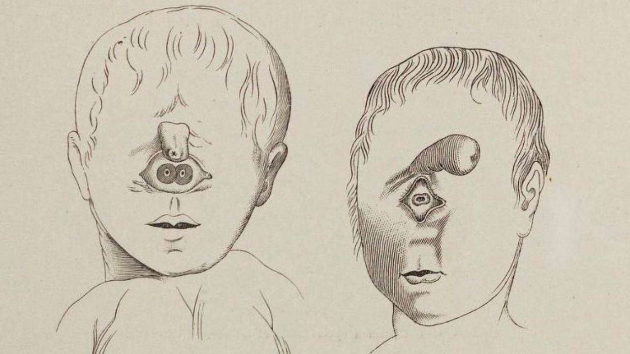 Meral Erden: Tek Gözlü Bebeklere Neden Olan Bu Doğum Kusuru, Hangi Sebeplerden Dolayı Ortaya Çıkıyor? 15
