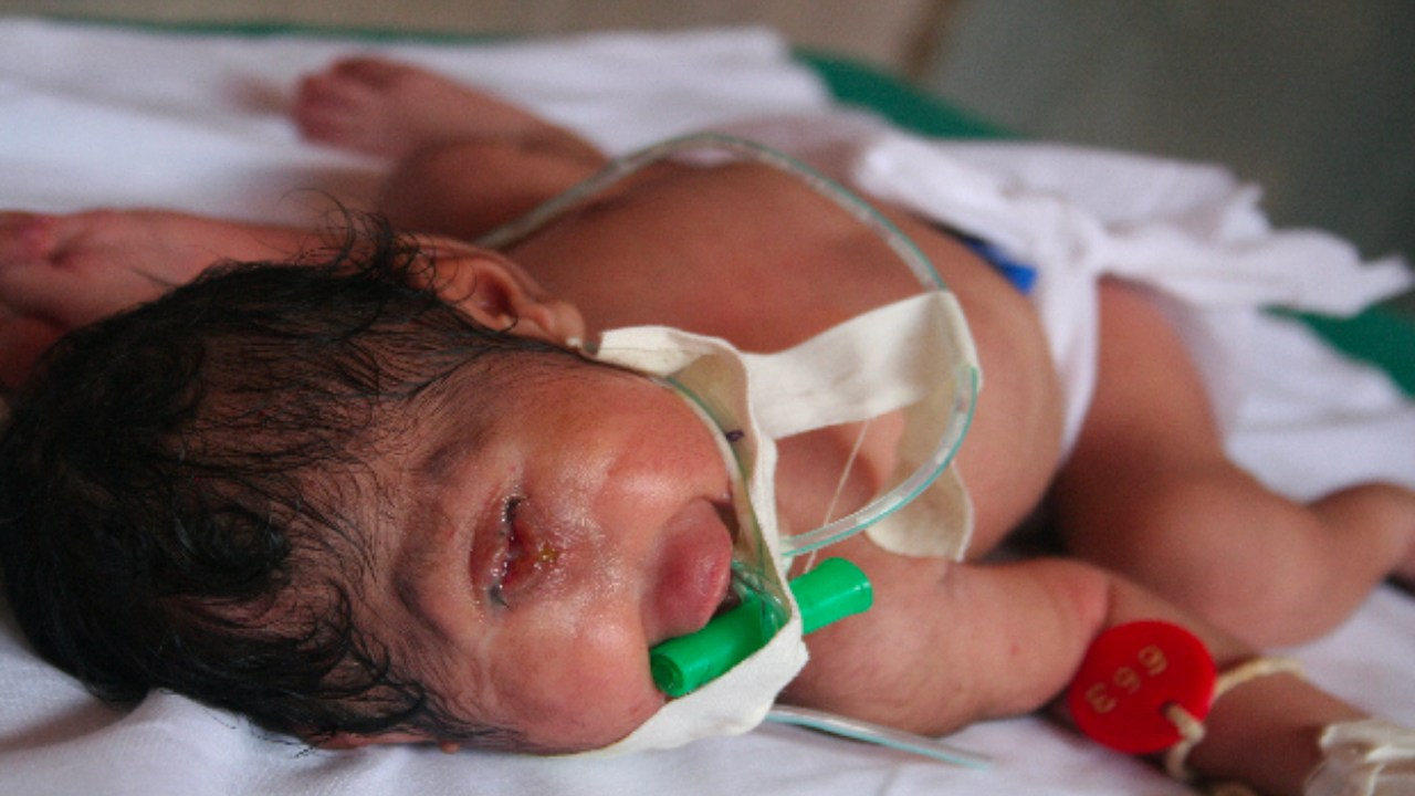 Şinasi Kaya: Tek Gözlü Bebeklere Neden Olan Bu Doğum Kusuru, Hangi Sebeplerden Dolayı Ortaya Çıkıyor? 3