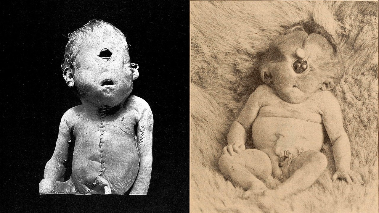 Meral Erden: Tek Gözlü Bebeklere Neden Olan Bu Doğum Kusuru, Hangi Sebeplerden Dolayı Ortaya Çıkıyor? 21