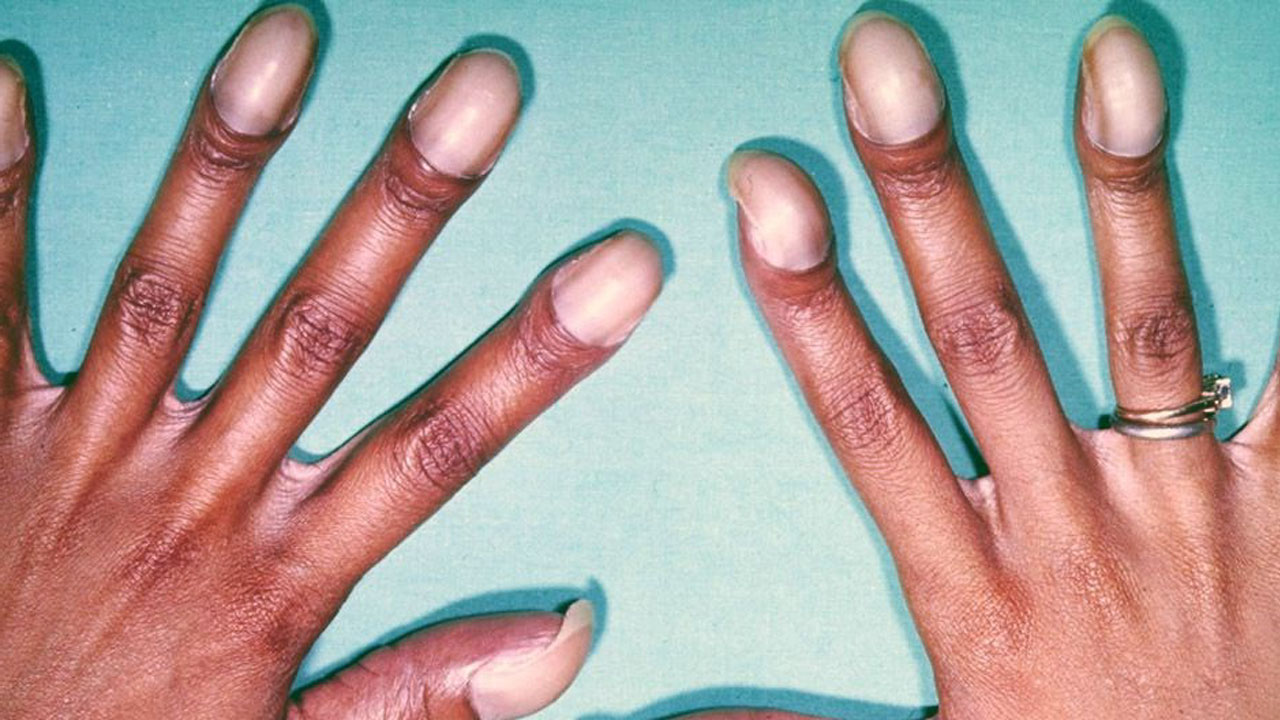 İnanç Can Çekmez: Parmaklarınızla Bu Testi Uygulayarak Olası Bir Hastalığınızı Erken Teşhis Edebileceğinizi Biliyor Muydunuz? 7