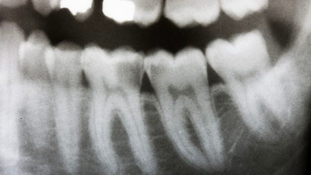 Meral Erden: Vipeholm Deneyi: Diş Çürüklerinin Sebebini Keşfetmek Keşke Bu Kadar Acımasızca Olmasaydı! 5