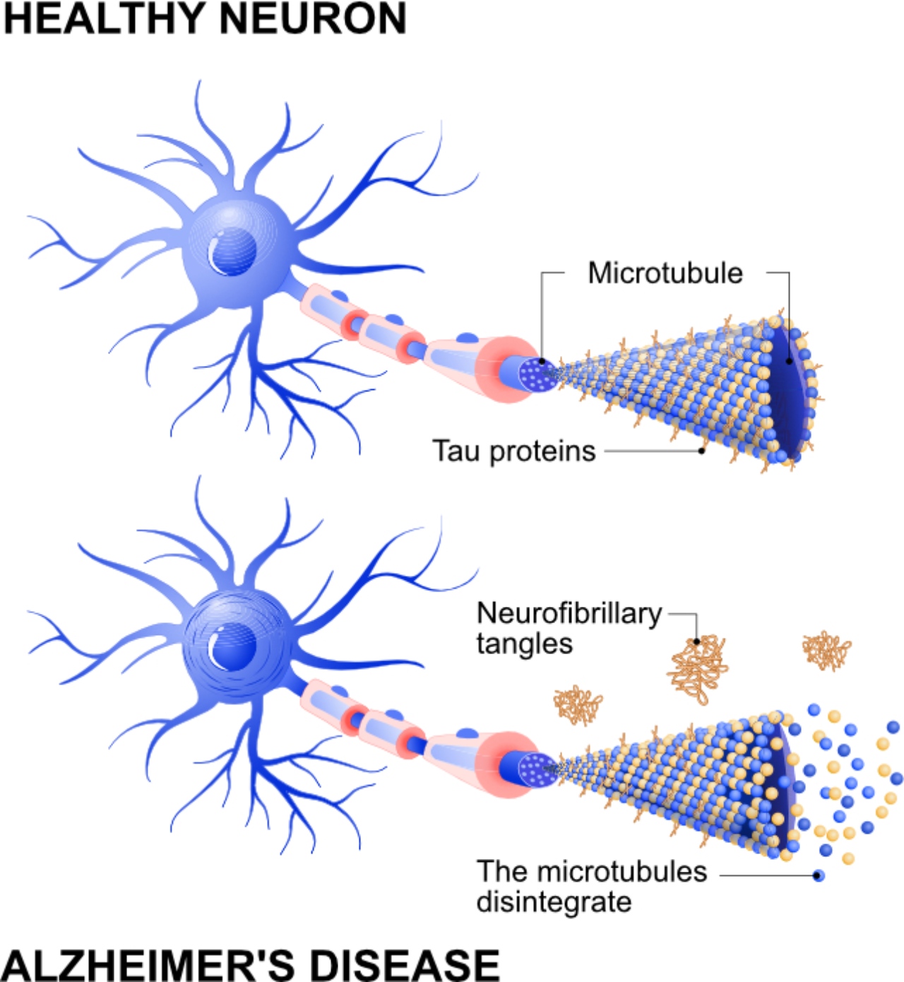 Alzheimer Hastalığı Ve Yeni Araştırmalar